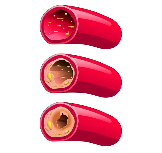 Cholesterol particles slowly accumulate over time.