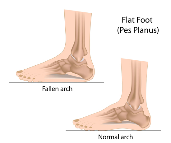 How Does Running Affect Me If I Have Flat Feet?