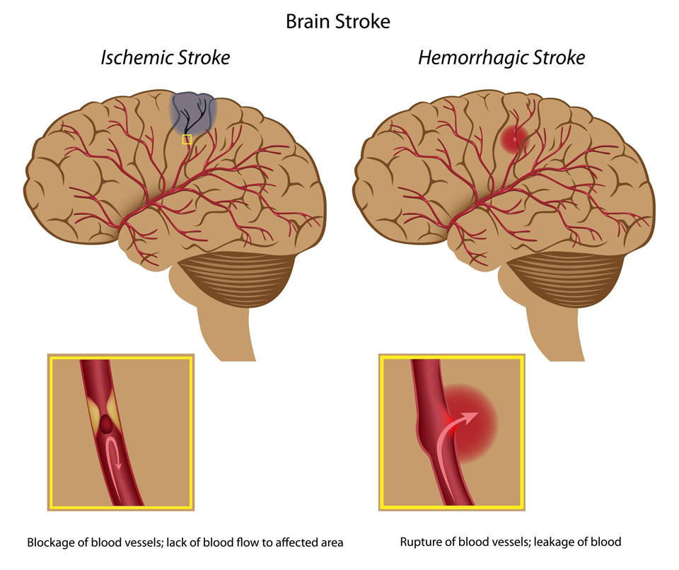 Can We Prevent Stroke Just By Running?