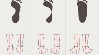 How Does Running Affect Me If I Have Flat Feet?