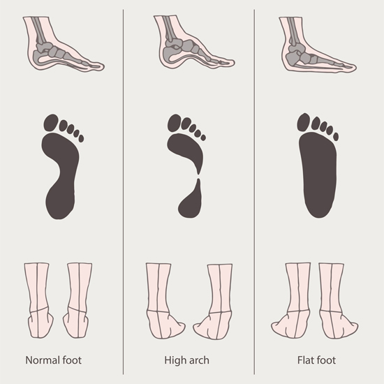 How Does Running Affect Me If I Have Flat Feet?