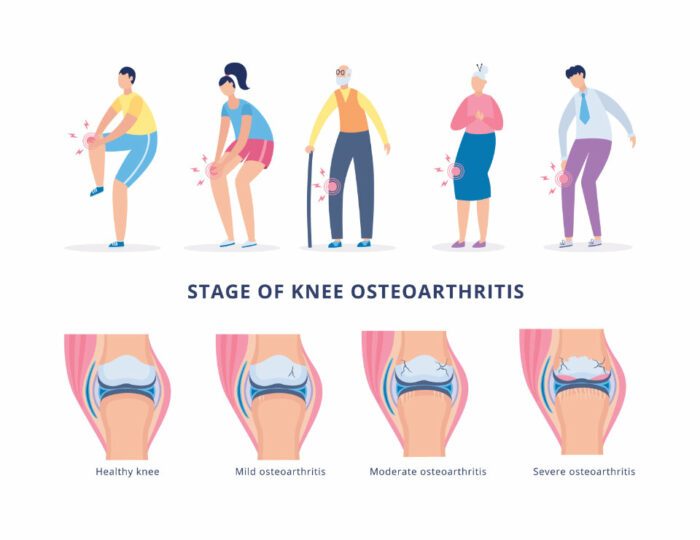 Can Running Increase the Risk of Hip and Knee Osteoarthritis?