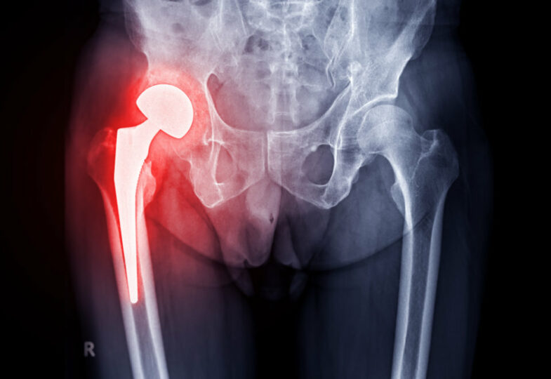 Can Running Increase the Risk of Hip and Knee Osteoarthritis?